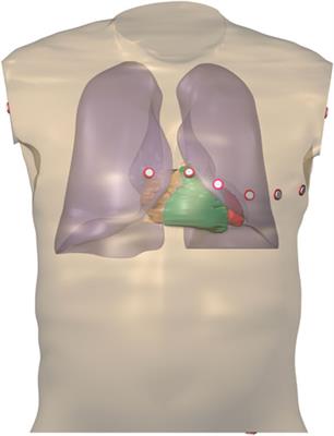 Differences in ventricular wall composition may explain inter-patient variability in the ECG response to variations in serum potassium and calcium